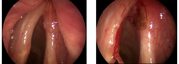 Treatment of Voice Disorders - ENT London