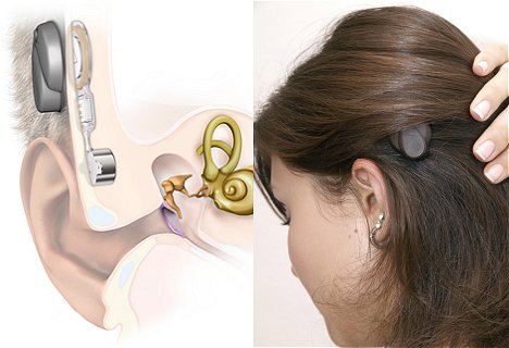 Medel Bonbridge Hearing Implant
