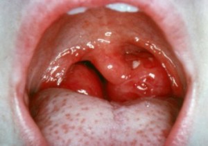 Obstructive Tonsils
