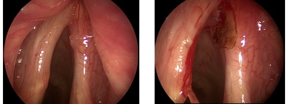 Laryngeal cancer