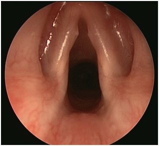 Vocal nodules